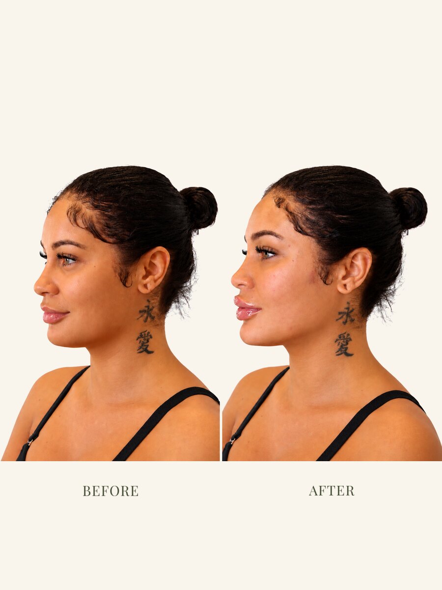 Chin, jaw, cheek, and lip filler before and after, profile view