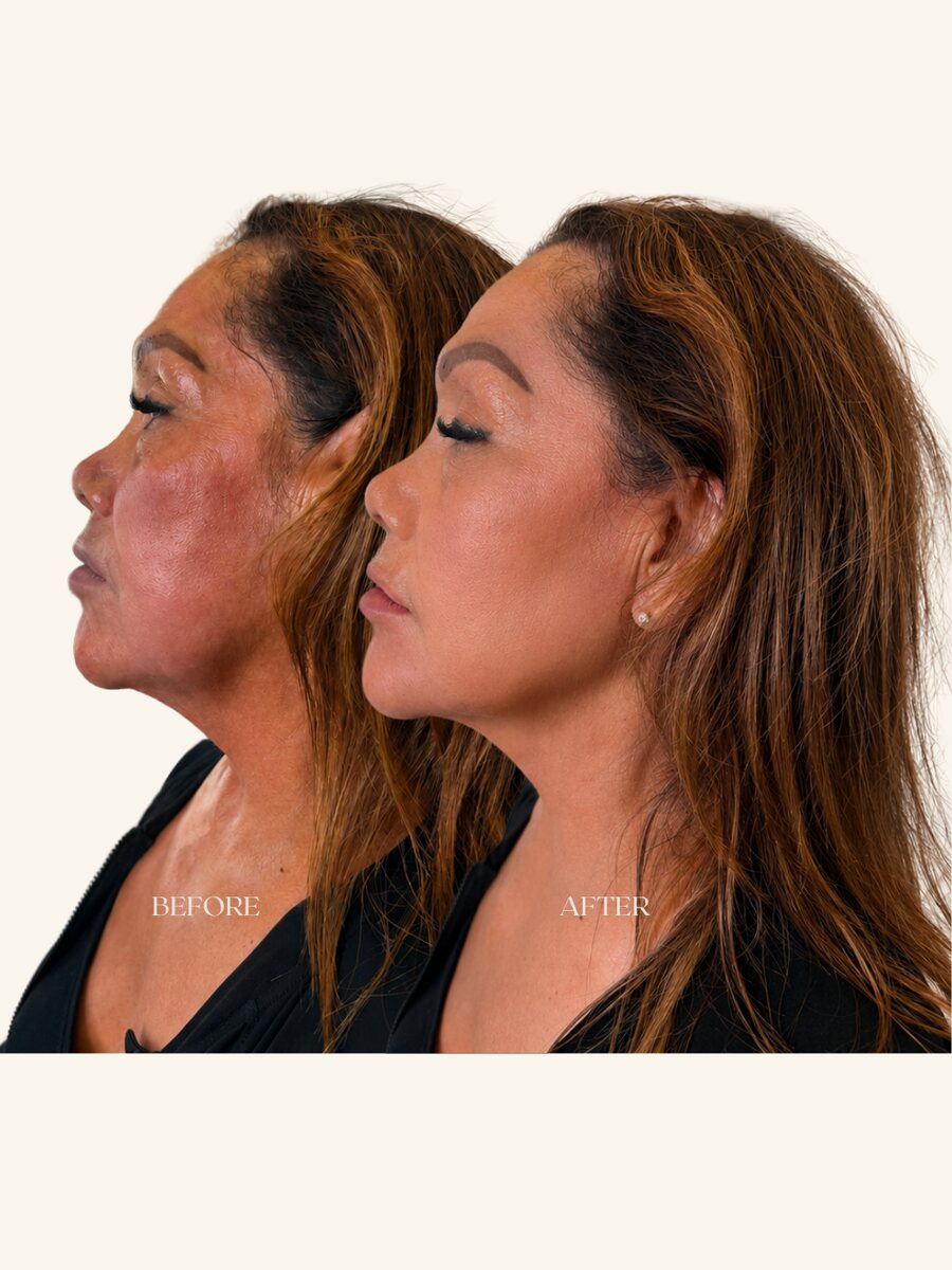 Full face balancing before and after