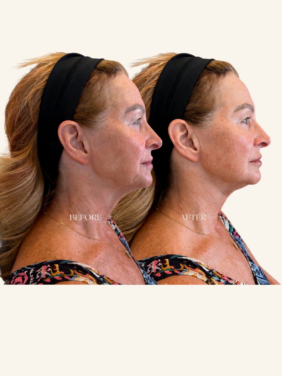 Full face rejuvenation before and after
