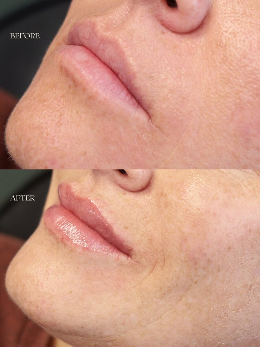 Lip filler before and after, profile view