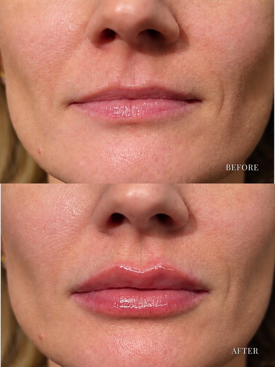 Lip augmentation before and after