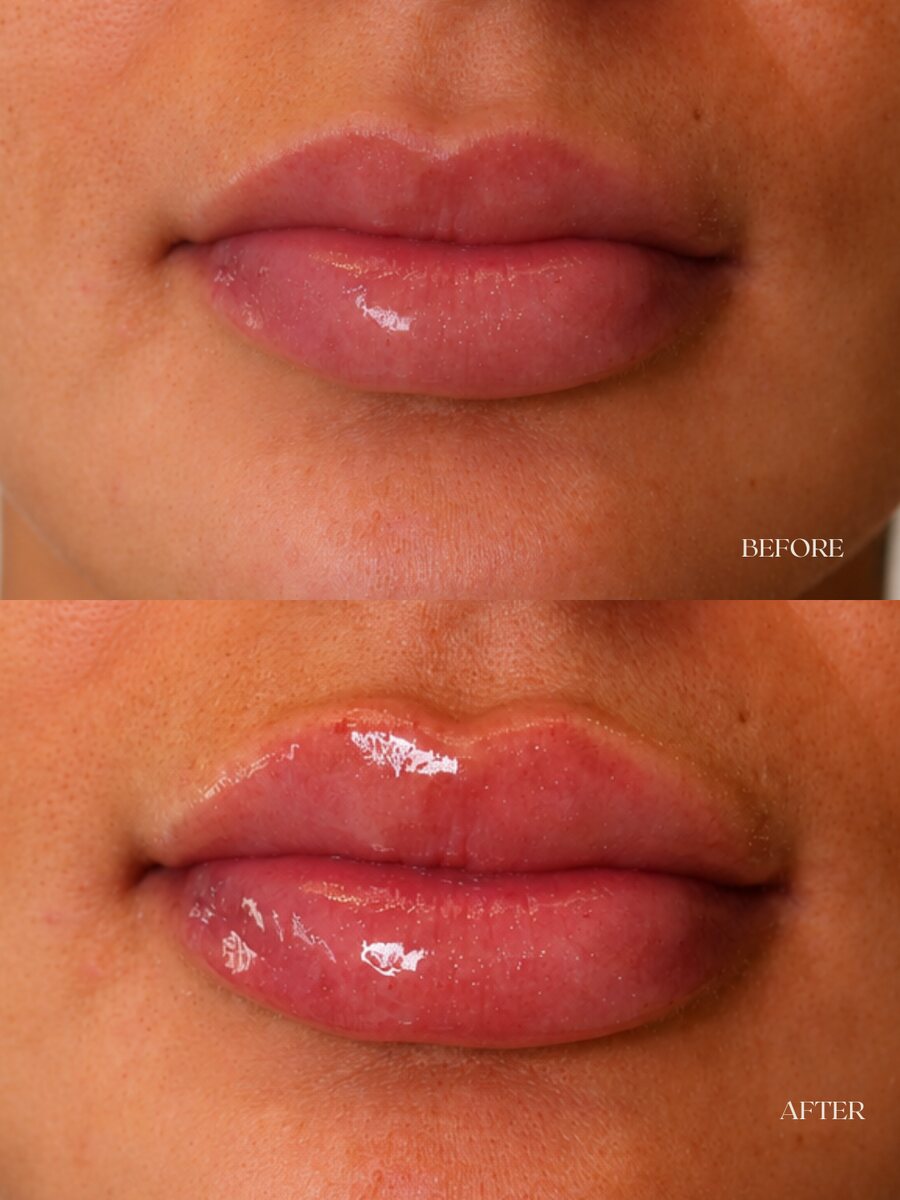 Lip enhancement before and after