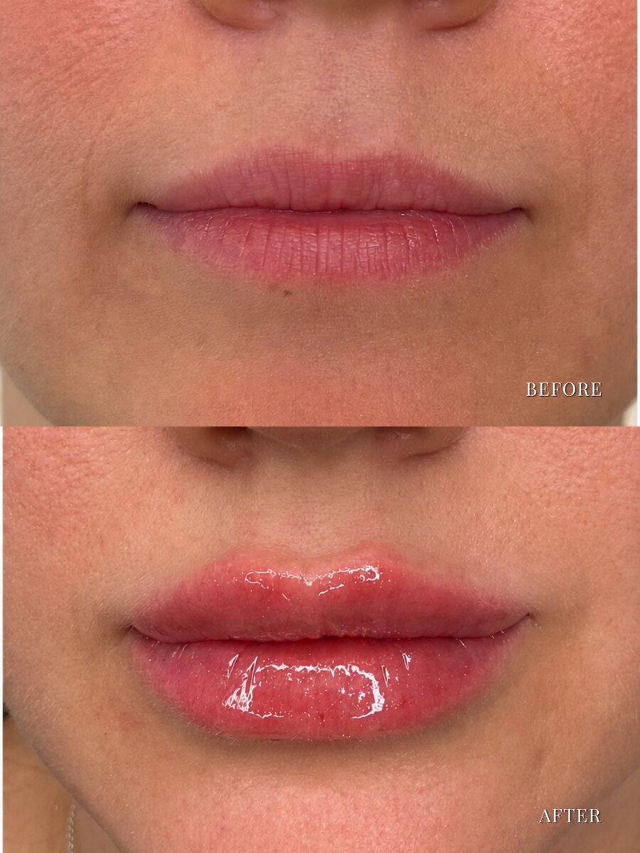 Lip filler before and after, front view