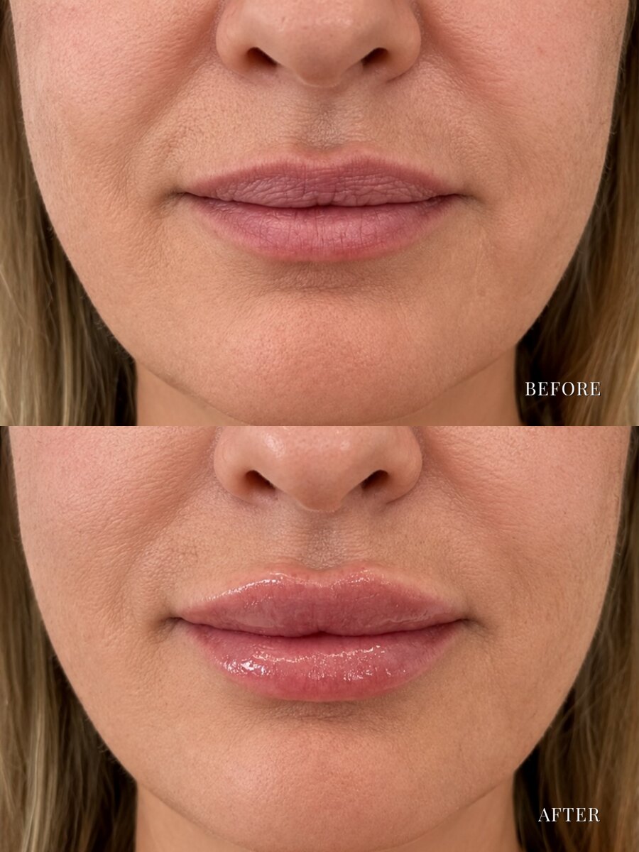 Lip filler before and after, front view with added volume