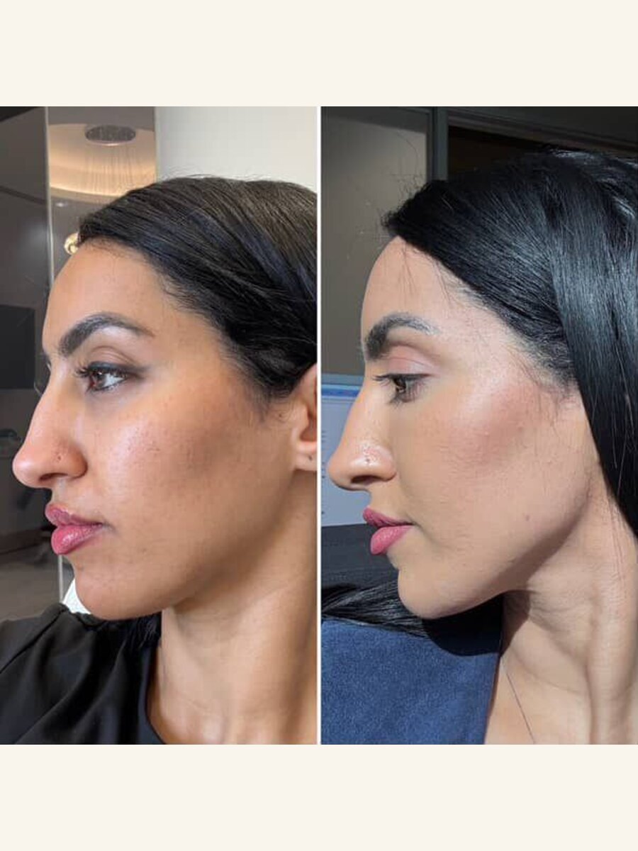 Jawline contouring before and after